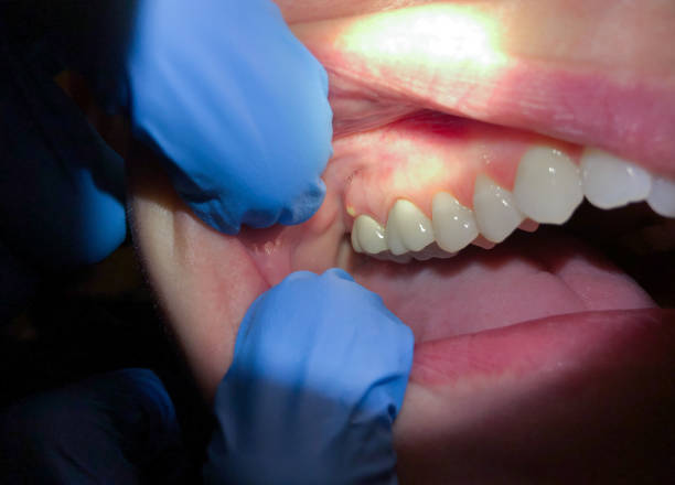 Best Emergency Cosmetic Dentistry (e.g., broken veneers) in Wilburton, OK